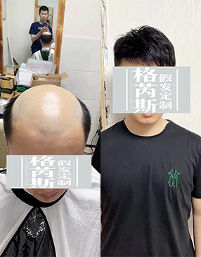 男生增發(fā)可以試試物理增發(fā)織發(fā)補(bǔ)發(fā)產(chǎn)品，這種可以快速增加發(fā)量，達(dá)到密發(fā)效果