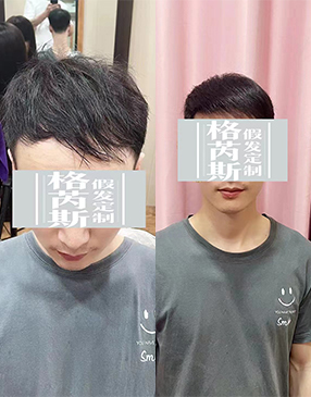 定制補(bǔ)發(fā)及以后日常大力是必不可少的，良好的使用習(xí)慣讓假發(fā)更好看
