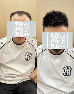 測(cè)量后，與客戶(hù)溝通需要定制的樣式造型和發(fā)長(zhǎng)制定，確定補(bǔ)發(fā)方案